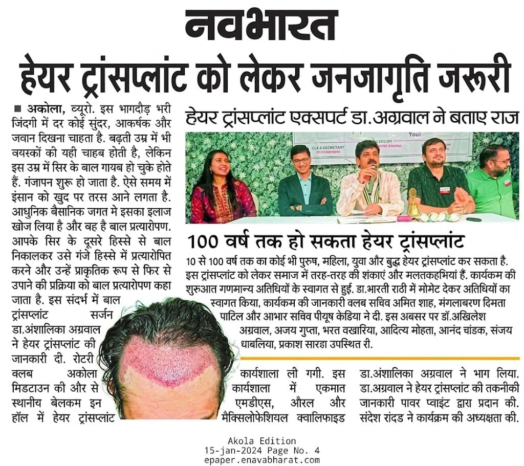 Navbharat newspaper feature on hair transplant awareness