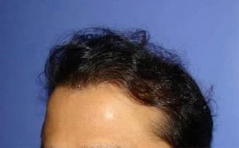 Hair transplant patient 1 — after