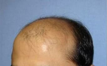 Hair transplant patient 1 — before