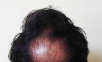 Hair transplant patient 2 — before